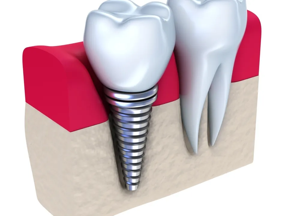Illustration of a dental implant beside a natural tooth