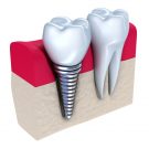 Implants and Crowns